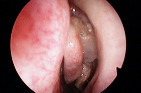 Papilloma nasale sintomi, Inverted Papilloma of Nose - ENT dysbiosis eubiosis