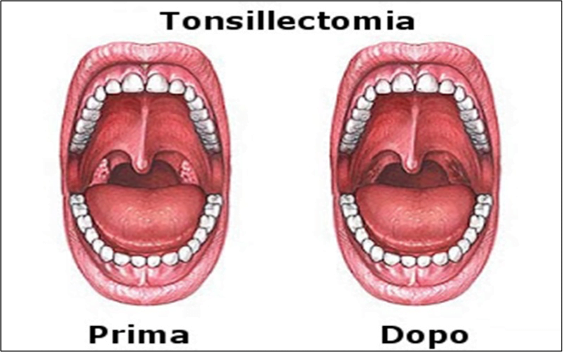 Risultati immagini per tonsillectomia