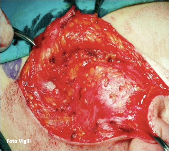 Anatomia chirurgica parotide nervo facciale 