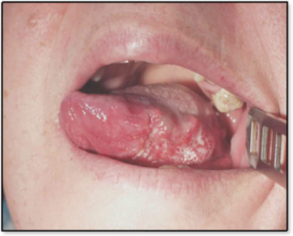 Tumori del Cavo Orale