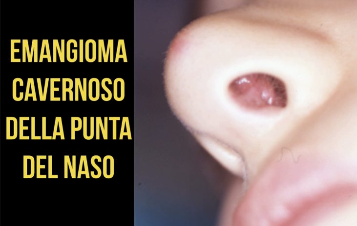 Papilloma al naso Papilloma invertito naso sintomi, Papilloma nel naso