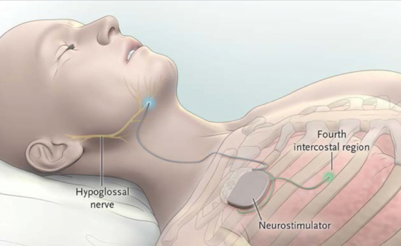 OSAS e stimolazione del nervo ipoglosso