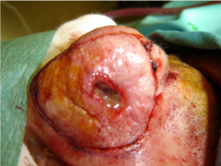 tumori cutanei epiteliali