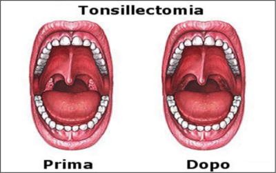 tonsillectomia