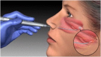 ablazione endoscopica laser