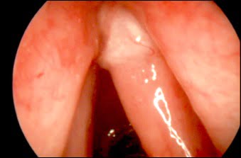 Displasia laringea