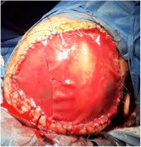 Carcinoma squamocellulare del cuoio capelluto intervento