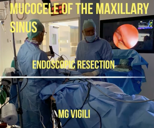 Mucocele Del Seno Mascellare Prof Maurizio Vigili