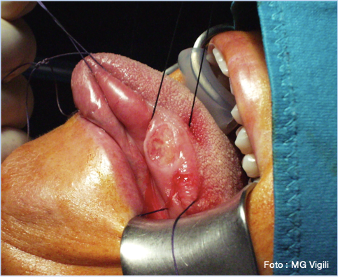 tumori del cavo orale margine chirurgico sano