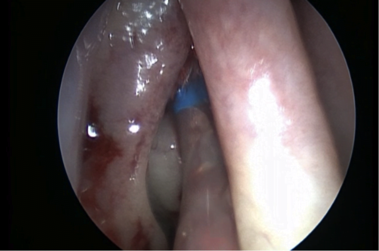 Senotomia frontale dilatativa con Balloon Acclarent