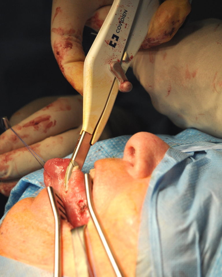 Partial glossectomy and sentinel node biopsy with Lugasure Small Jaw