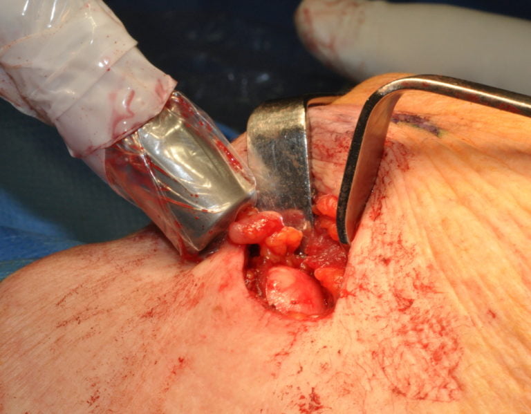 L’esperienza  personale  nelle Biopsia del Linfonodo Sentinella nei T1-T2 del Cavo orale