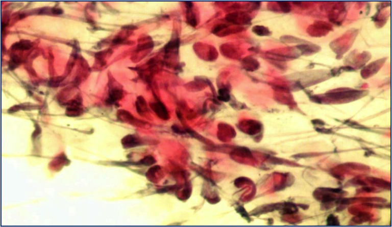 Importanza della Diagnostica Citologica Agoaspirativa nella patologia delle Ghiandole Salivari