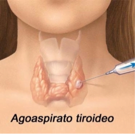 Agoaspirato tiroideo