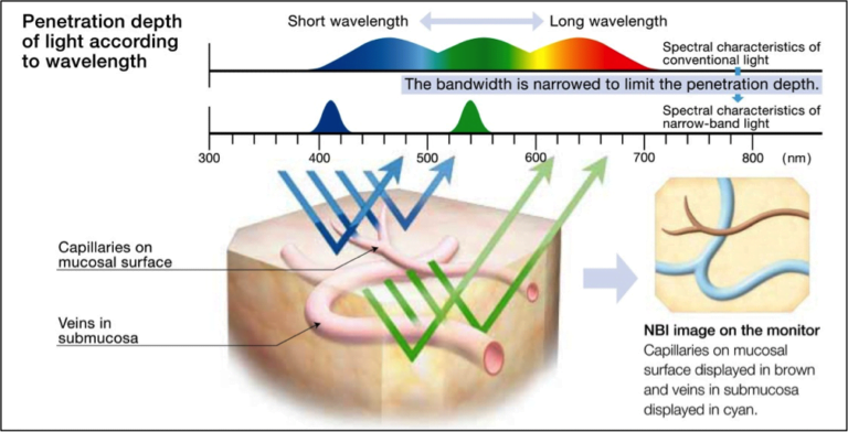 NBI una nuova  tecnologia  che permette di differenziare tumore da infiammazione nelle lesioni mucose delle VADS