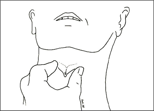 Disfagia muscolo-tensiva: efficacia della manipolazione laringea