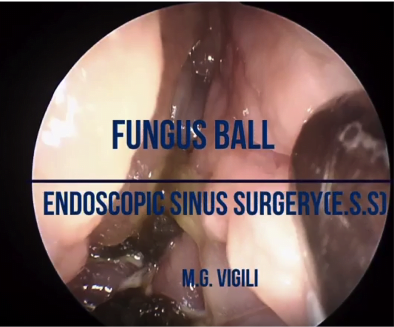 FUNGUS BALL: Trattamento endoscopico rinosinusale (E.S.S.)