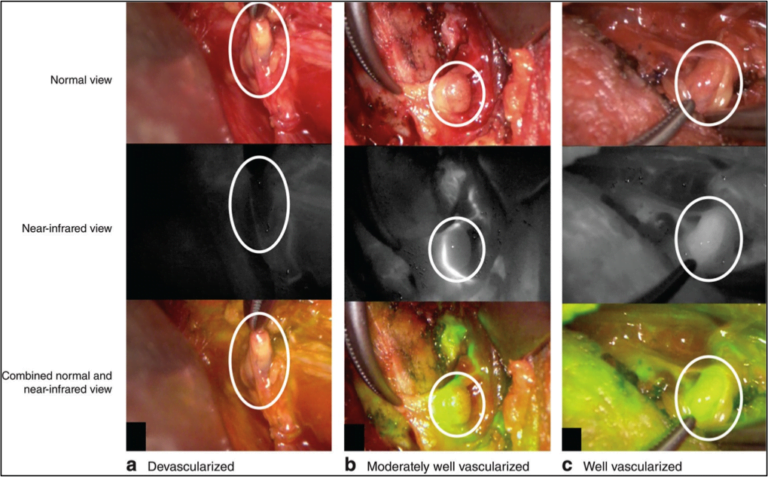 Ipoparatiroidismo post-operatorio: angiografia