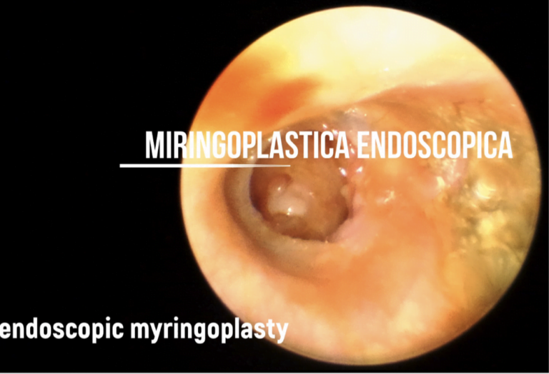Miringoplastica Endoscopica – Video
