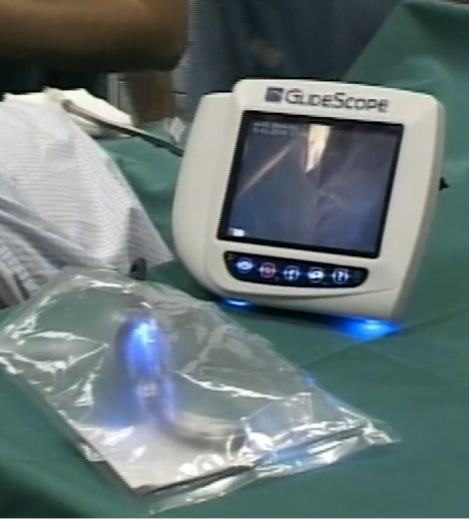 Intubazione con Glide Scope®