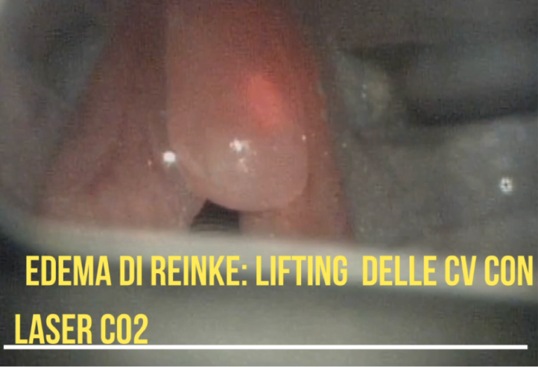 Edema di Reinke Lifting Laser CO2