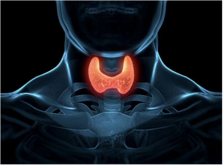 carcinomi papilliferi della tiroide