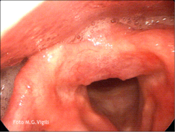Reflusso Gastroesofageo: la malattia aumenta il rischio di sviluppare tumore della laringe