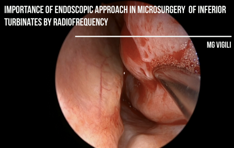 Turbinati con Radiofrequenza: approccio Endoscopico in Microchirurgia
