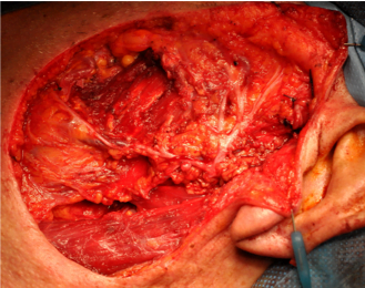 tumori cutanei epiteliali 