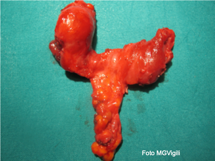 Carcinoma papillifero tiroide