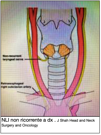 Tiroide: la ricerca del nervo ricorrente