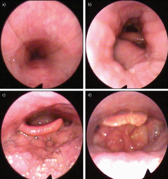 OSAS Epiglottis Stiffening Operation