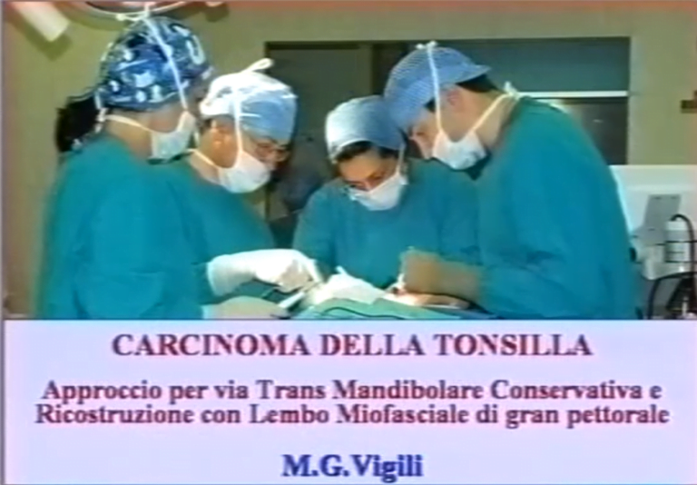 Carcinoma della tonsilla