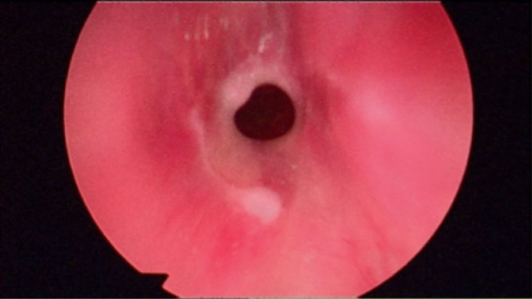 Stenosi sottoglottica idiopatica