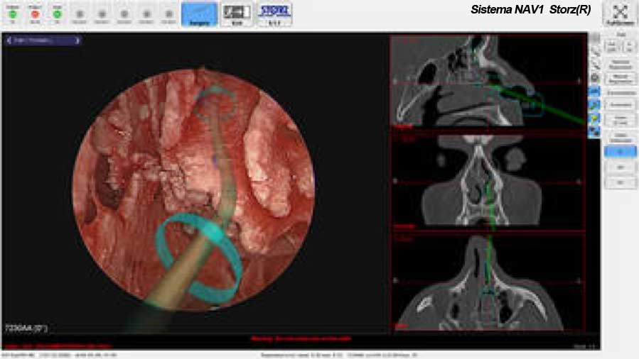 chirurgia endoscopica rinosinusale