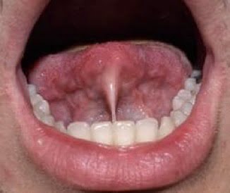 Frenulo corto linguale (anchiloglossia)