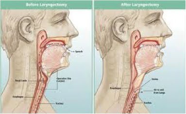la laringectomia