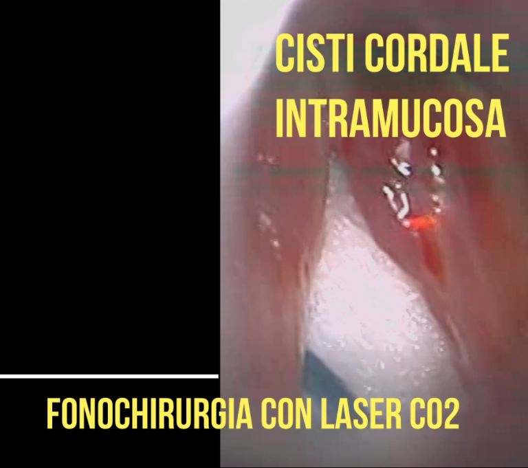 Cisti Intracordale: Fonochirurgia con Laser Co2