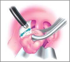 Coblation Tonsillectomy: nuova tecnica diminuisce rischio emorragia