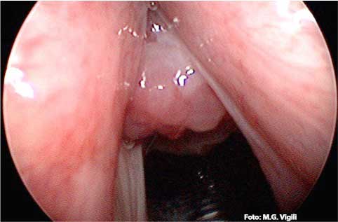 Granuloma laringeo da contatto