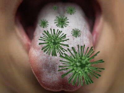 Tumore del cavo orale: nuove prospettive da biomateriali che modulano il microbiota