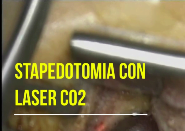 Stapedotomia con Laser CO2