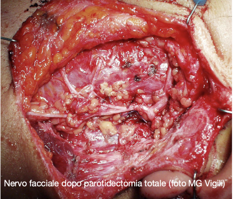 Epidemiologia dei tumori delle ghiandole salivari maggiori