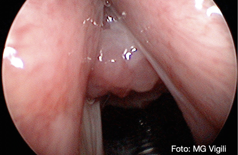 Granulomi da intubazione: ablazione con radiofrequenza