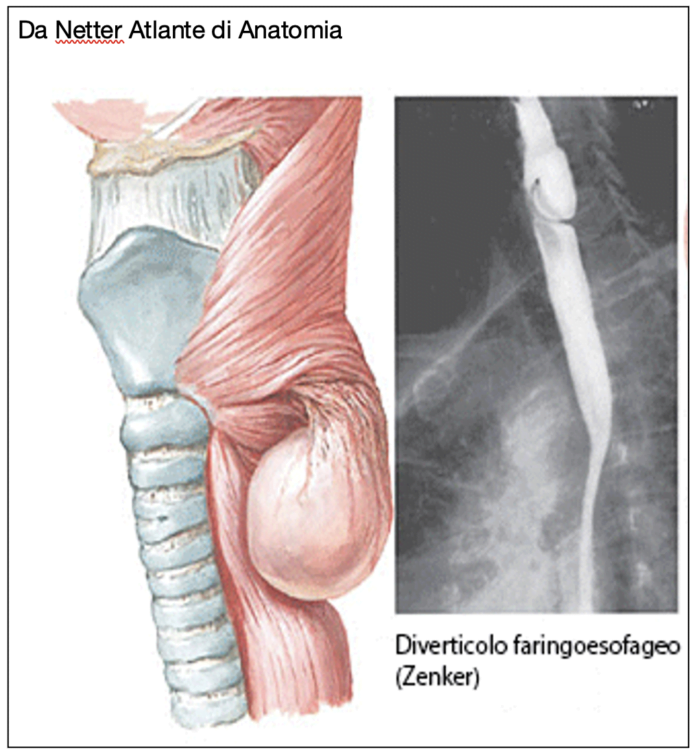 il diverticolo di Zenker
