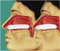 Effetti del tamponamento con Merocel sull’epitelio delle fosse nasali