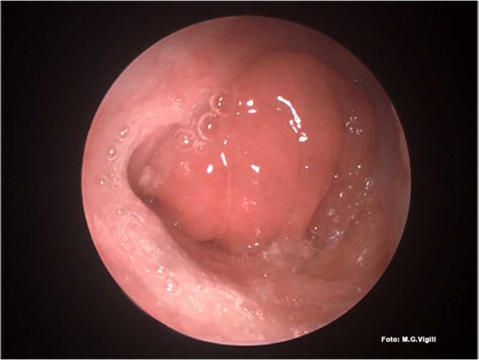 IPERTROFIA-ADENOIDEA
