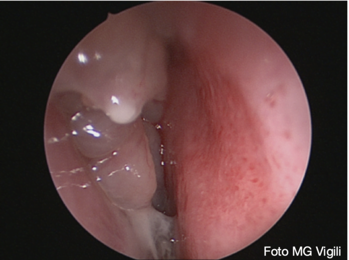 Raccomandazioni pratiche nella gestione della rinosinusite cronica con poliposi nasale severa nell’era dei biologici.
