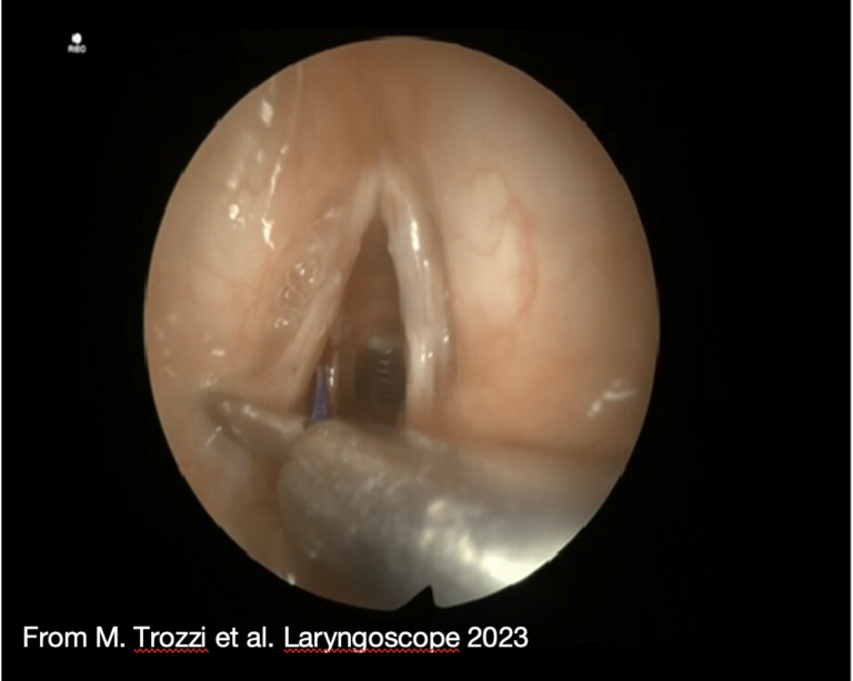 paralisi cordale bilaterale
