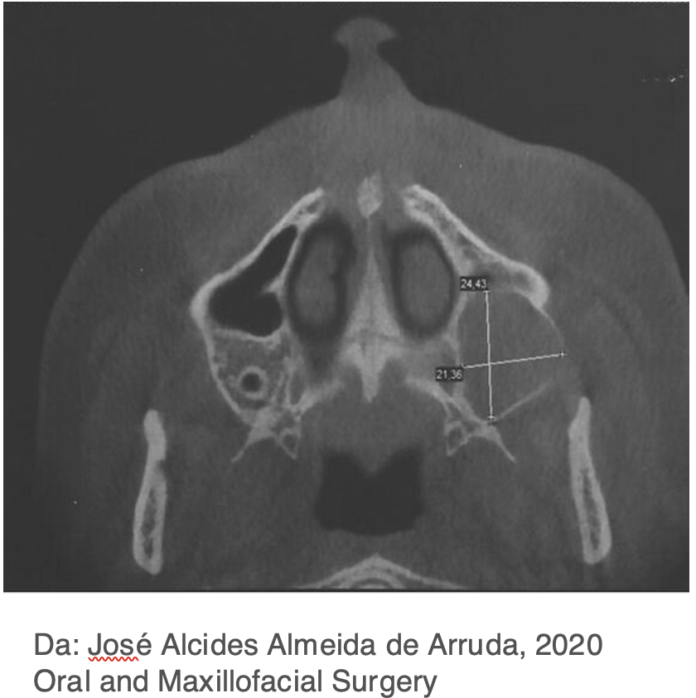 adenoid ameloblastoma